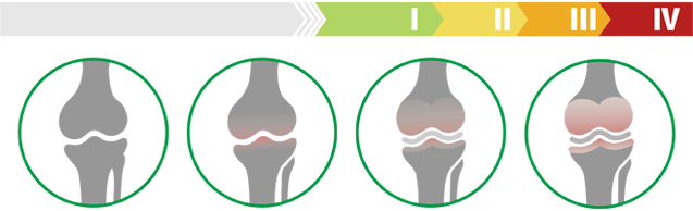 Клиничке фазе артрозе коленског зглоба (степен артрозе коленског зглоба)