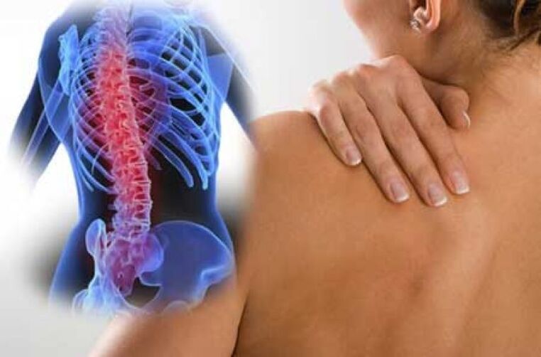 Током егзацербације остеохондрозе торакалне кичме, јавља се дорсаго бол