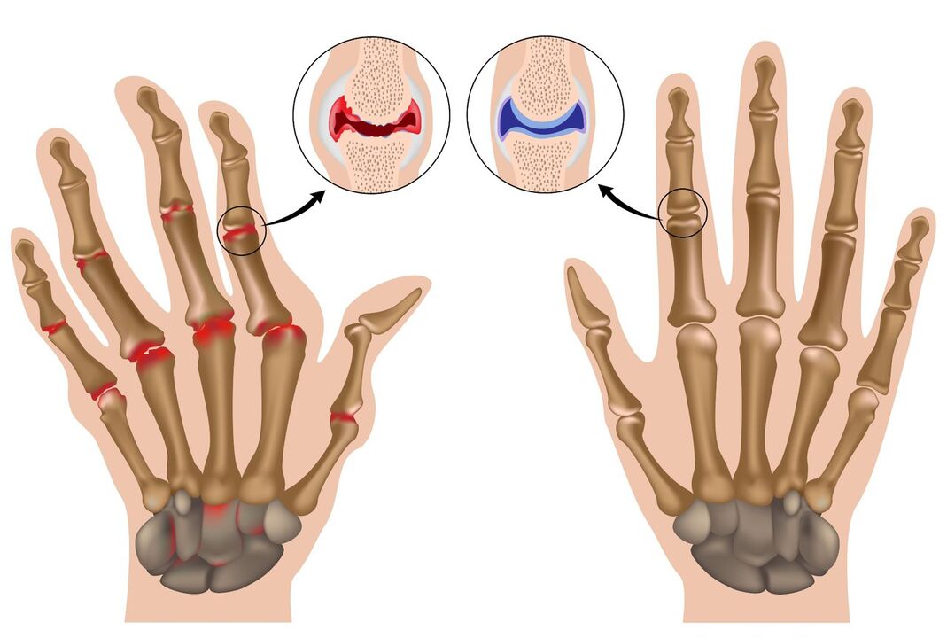 Здрави и полиартритисом захваћени зглобови руку